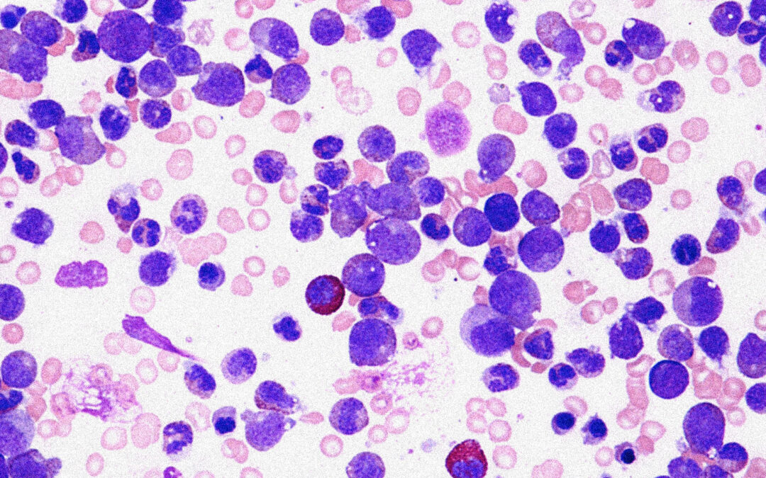 Patient outcomes study in Acute Myeloid Leukemia